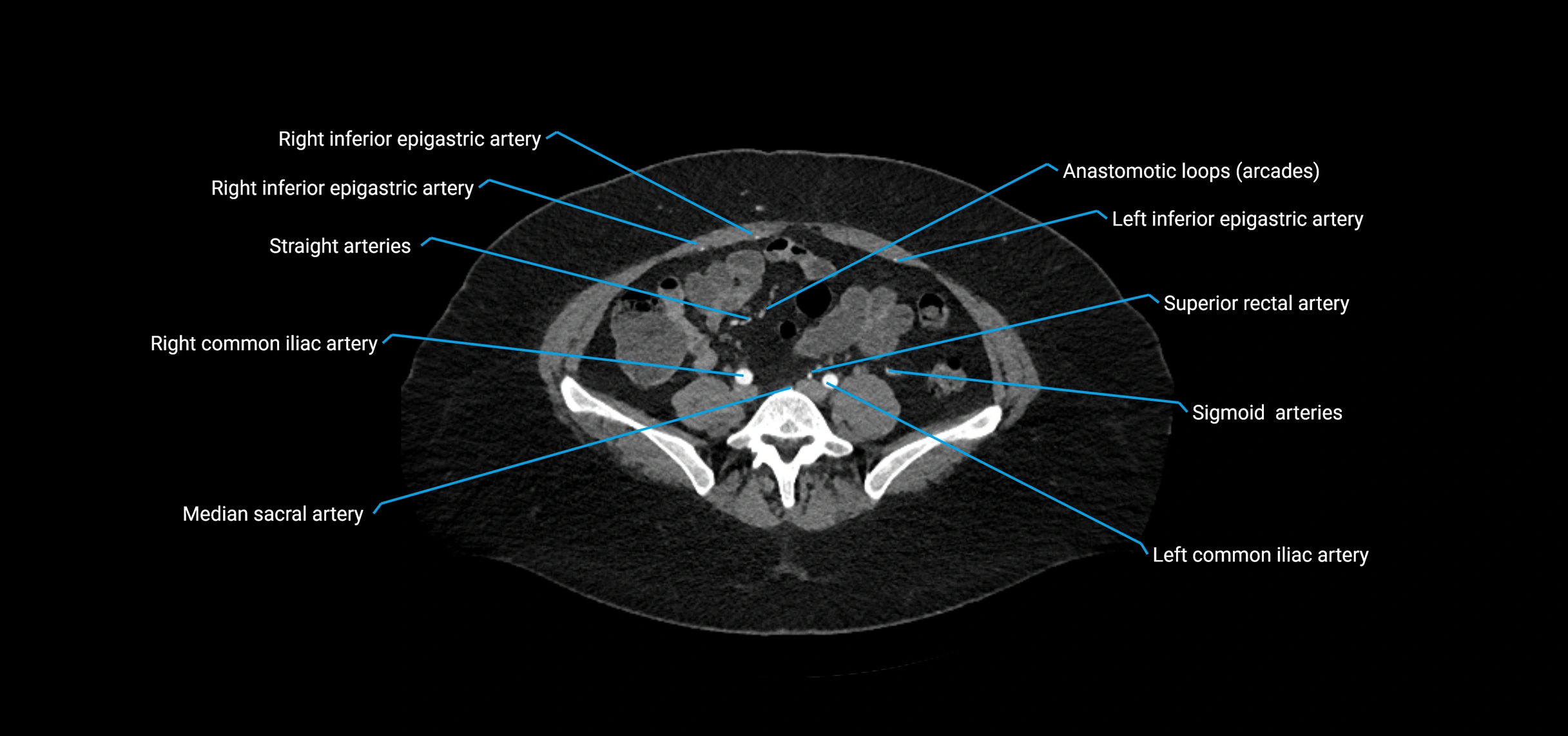 CTA abdomen axial cross sectional anatomy labelled image_164 (2).webp
